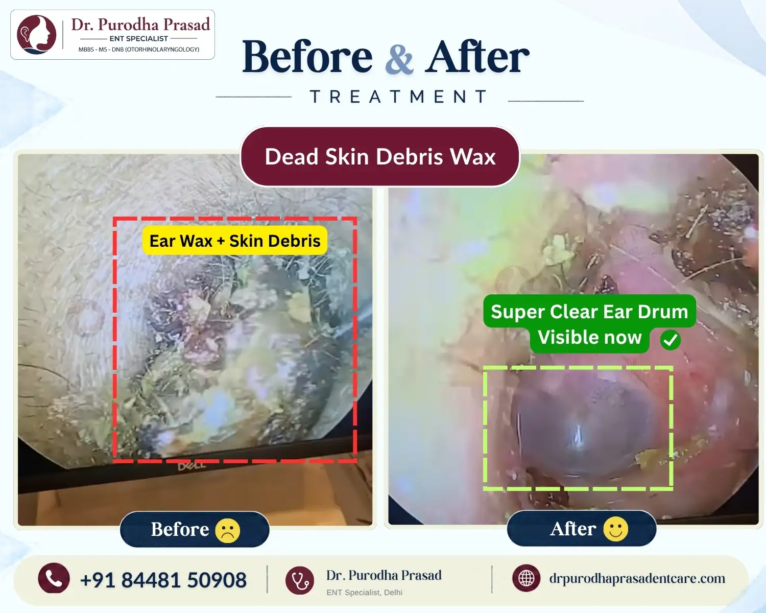 Ear Wax with Dead Skin Debris Removal in Delhi - Before & After Photo