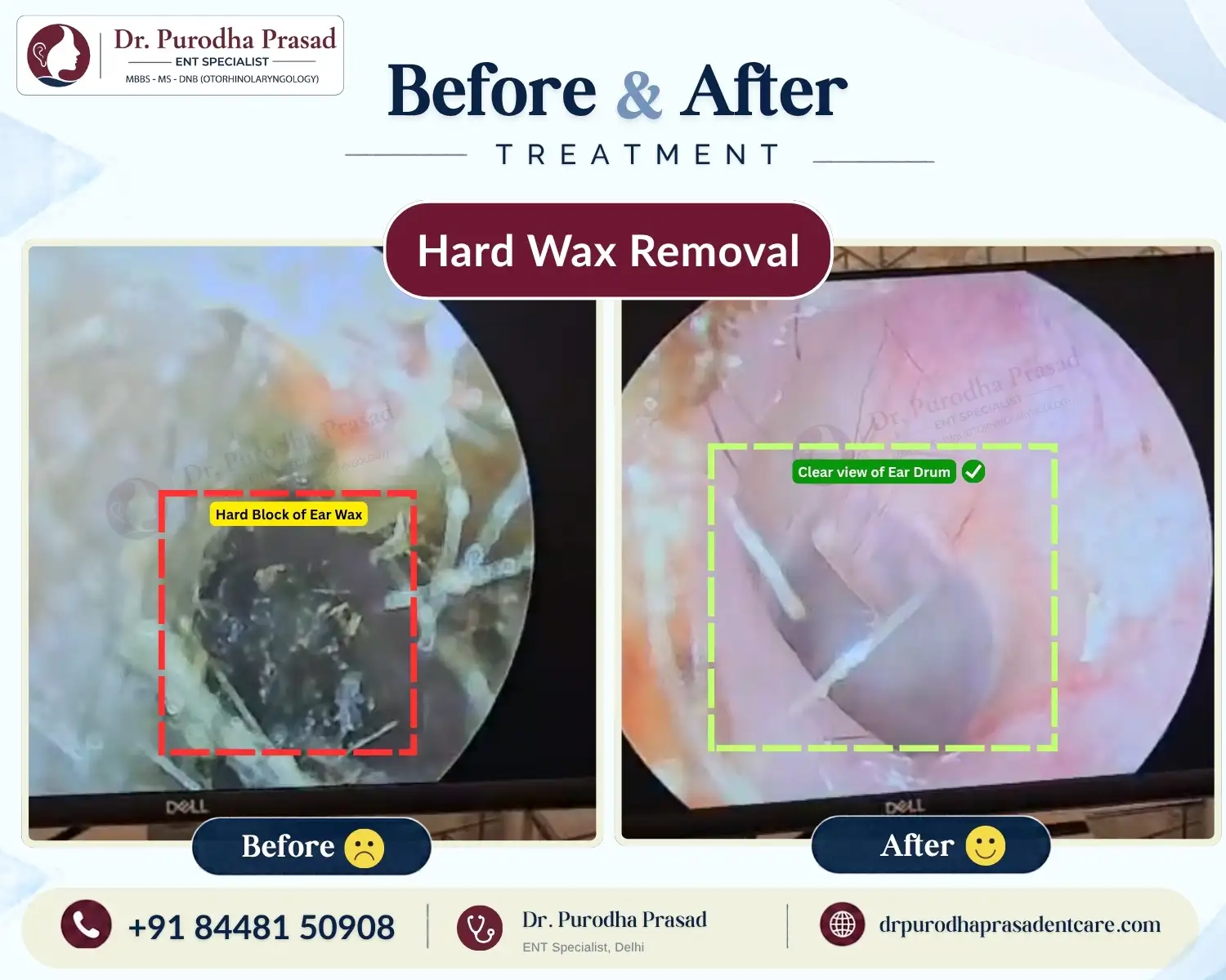 Hard Ear Wax Removal in Delhi - Before & After Photo