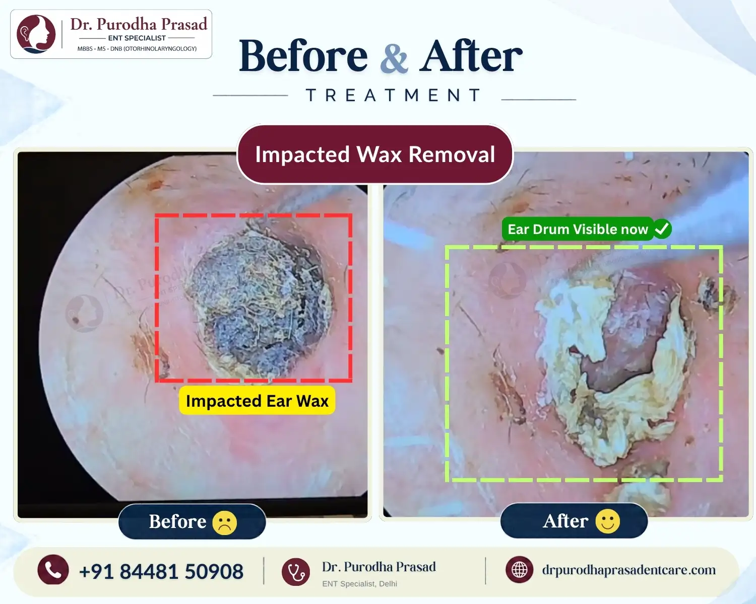 Impacted Ear Wax Removal in Delhi - Before & After Photo.