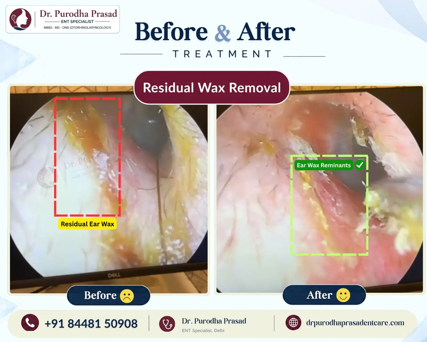 Residual Ear Wax Removal in Delhi - Before & After Photo