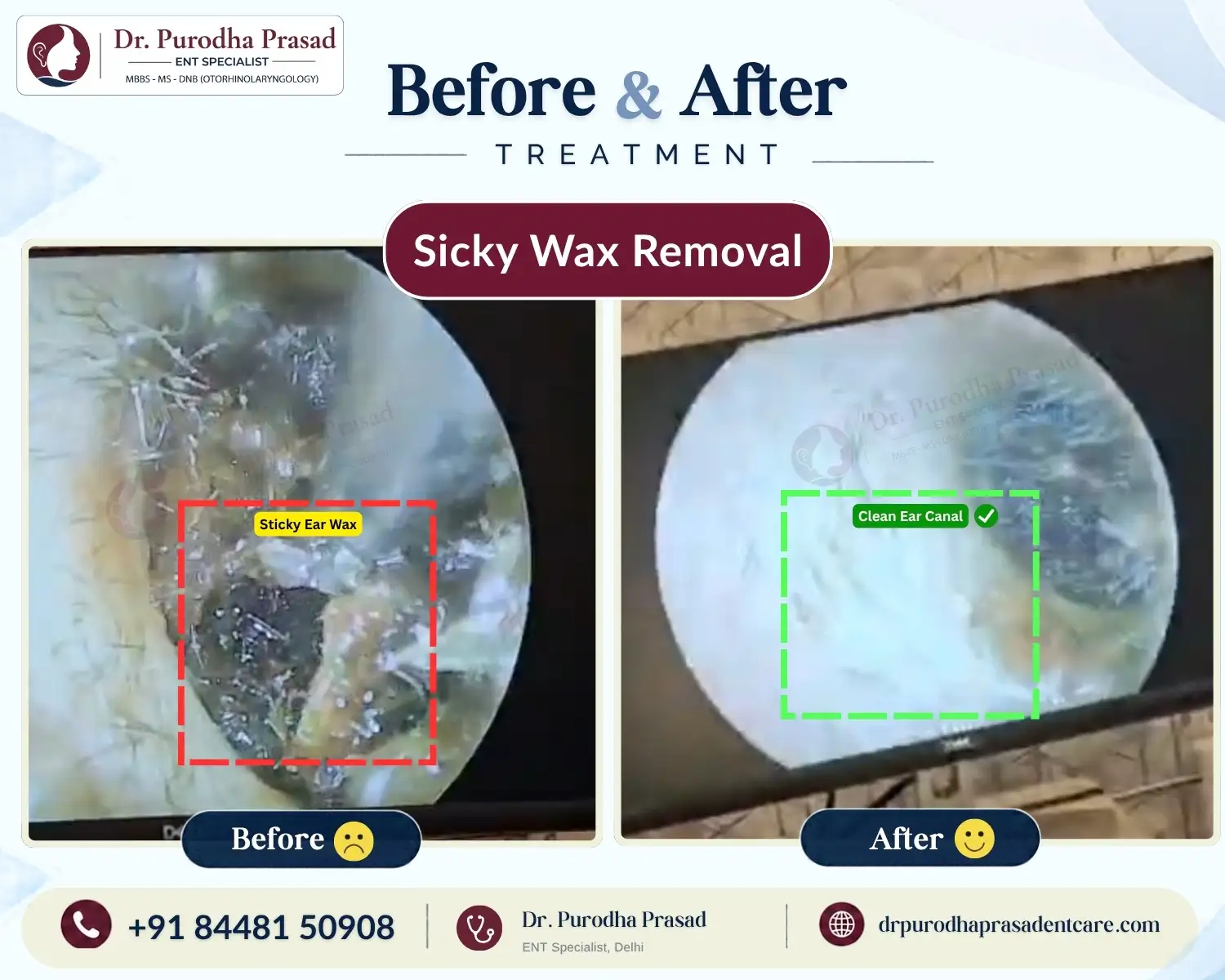 Sticky Ear Wax Removal in Delhi - Before & After Photo
